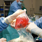 Préservation de greffon - préservation d'organe - transplantation
