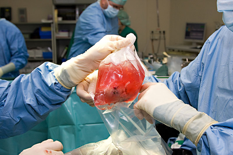 Préservation de greffon - préservation d'organe - transplantation