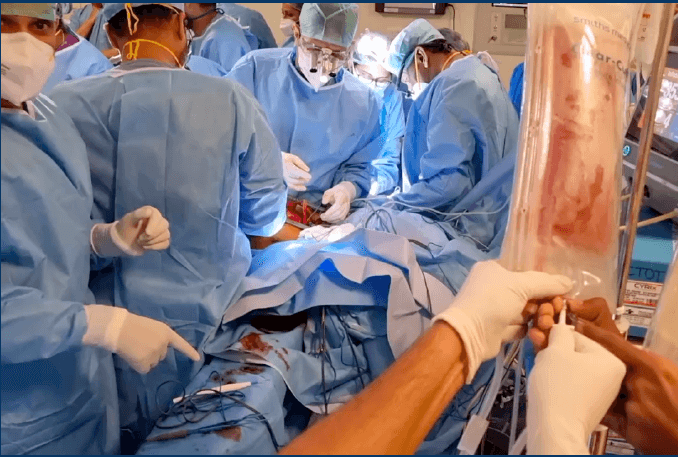 double greffe et transplantations d'organes grâce à l'utilisation d' HEMO2LIFE